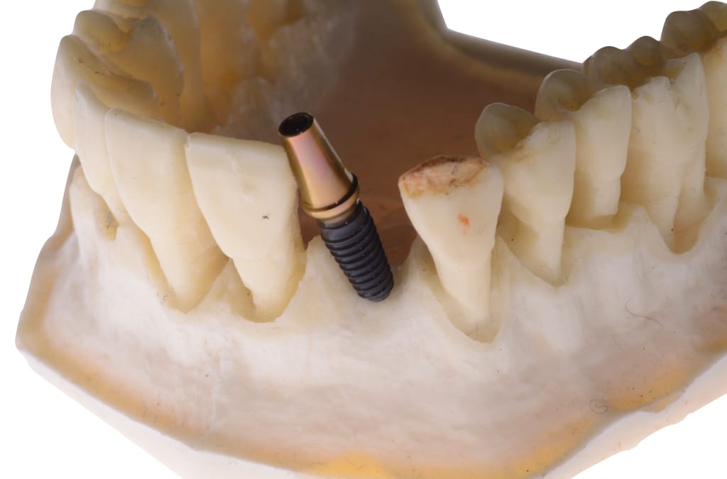 Perchè uso impianti a CONNESSIONE CONICA