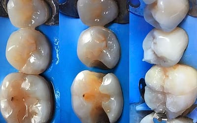 Otturazione? Come farla Quanto dura
