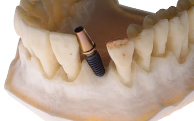 Perchè uso impianti a CONNESSIONE CONICA
