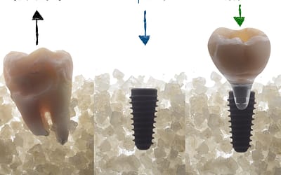 Cos’è un IMPIANTO DENTALE